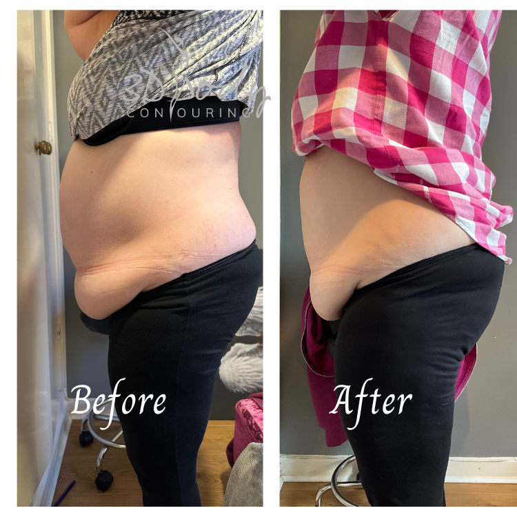 Tunbridge Wells 3D-BodyContouring - Day Spa in Tunbridge Wells