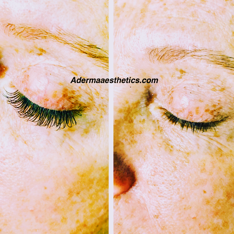 Aderma Aesthetics Pompano Beach - Day Spa in Pompano Beach