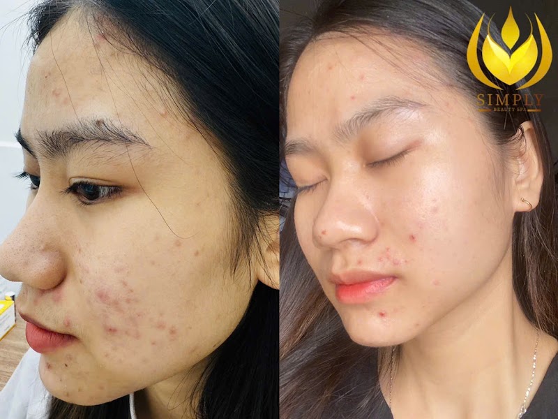 Simplybeauty Spa-Spa uy tín Gò Vấp-Chăm sóc Da-Thư giãn Cổ Vai Gáy -Gội đầu Detox-Lấy nhân mụn bằng tay Quận Gò Vấp - Day Spa in Quận Gò Vấp