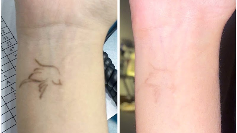 Xoá xăm Bình Chánh - Bí Beauty Huyện Bình Chánh - Day Spa in Huyện Bình Chánh